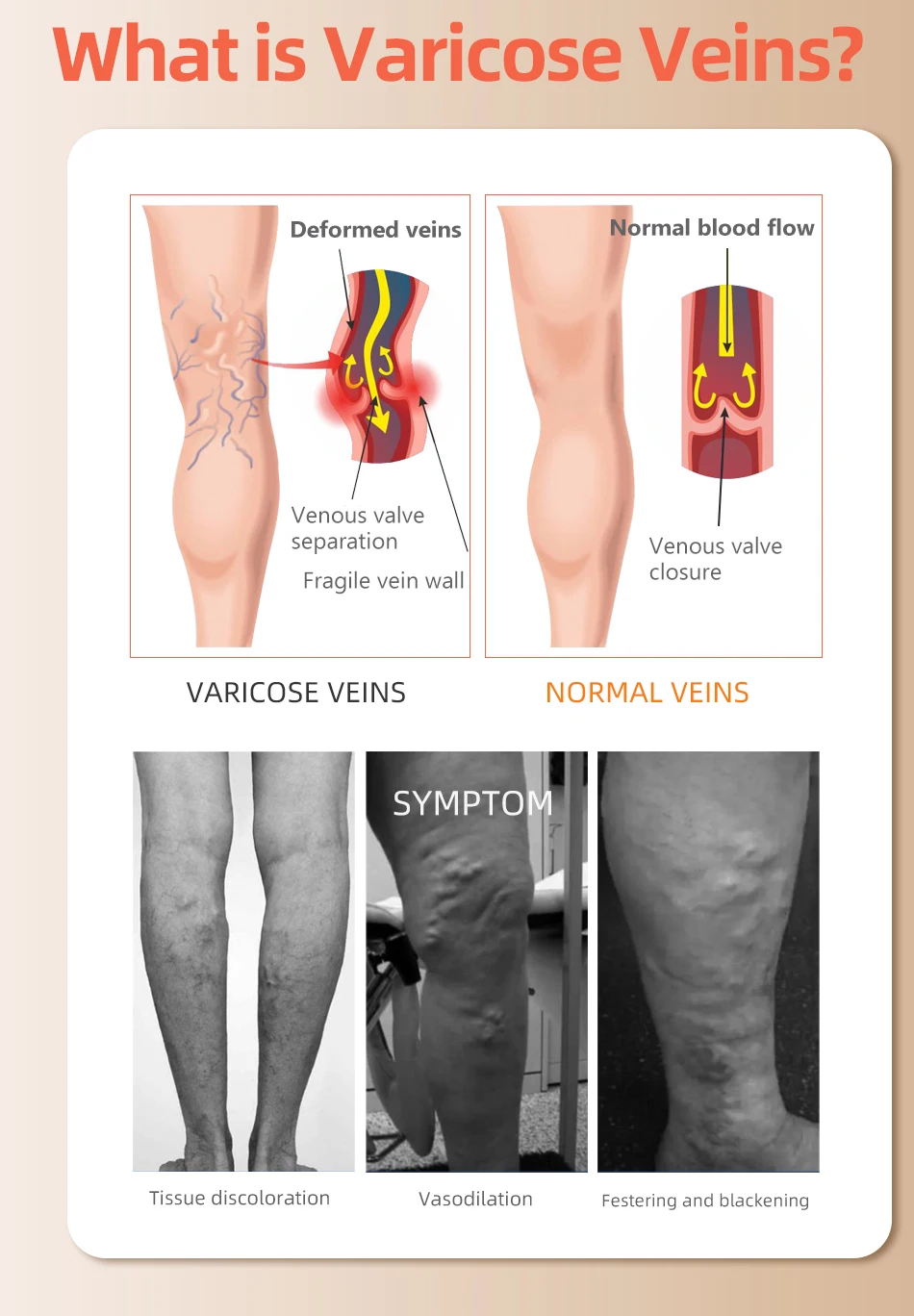 30-40 mmHg sobre o joelho fech - Compression Sock Medical avaliação e preço